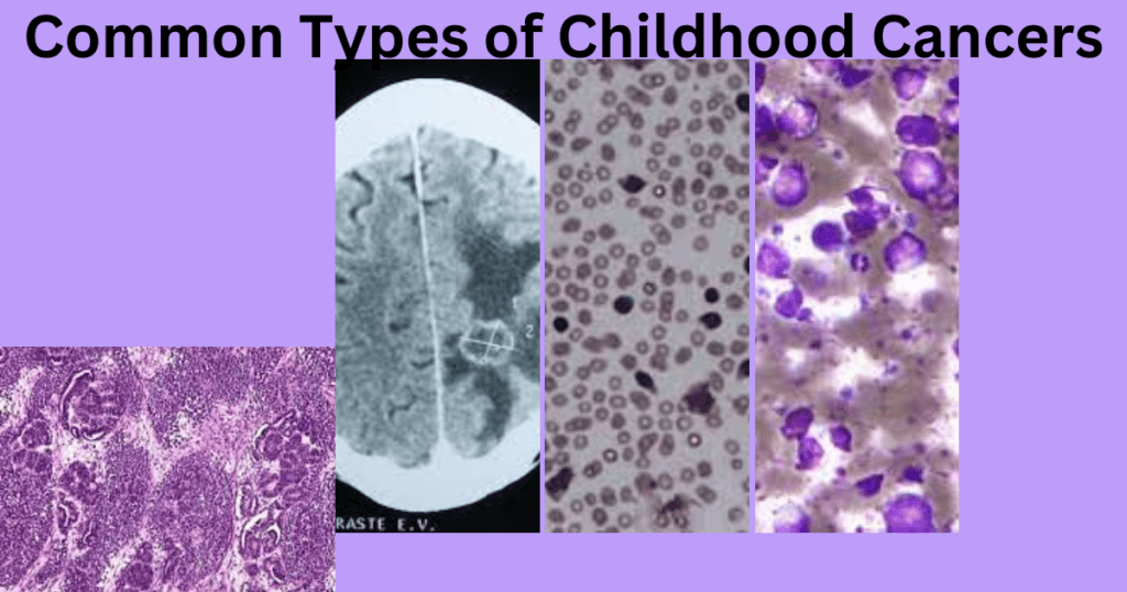 Most 4 Common Types Of Childhood CancersGuidelines On Preventing