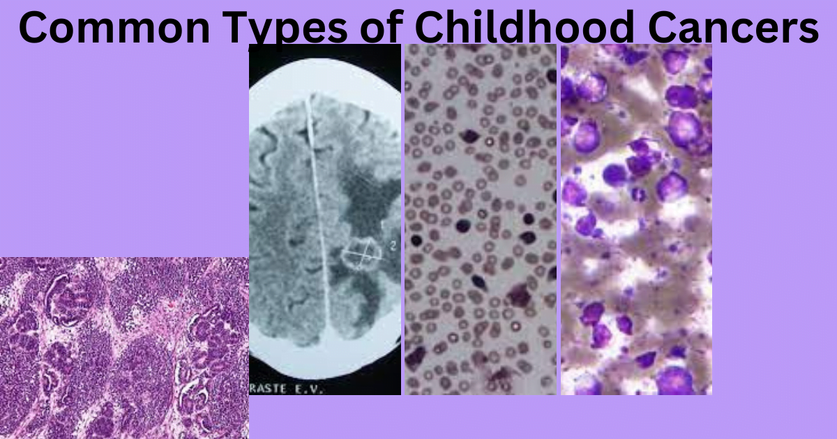 Common Types of Childhood Cancers