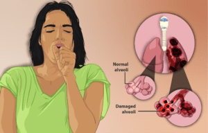 What Is Chronic Obstructive Pulmonary Disease