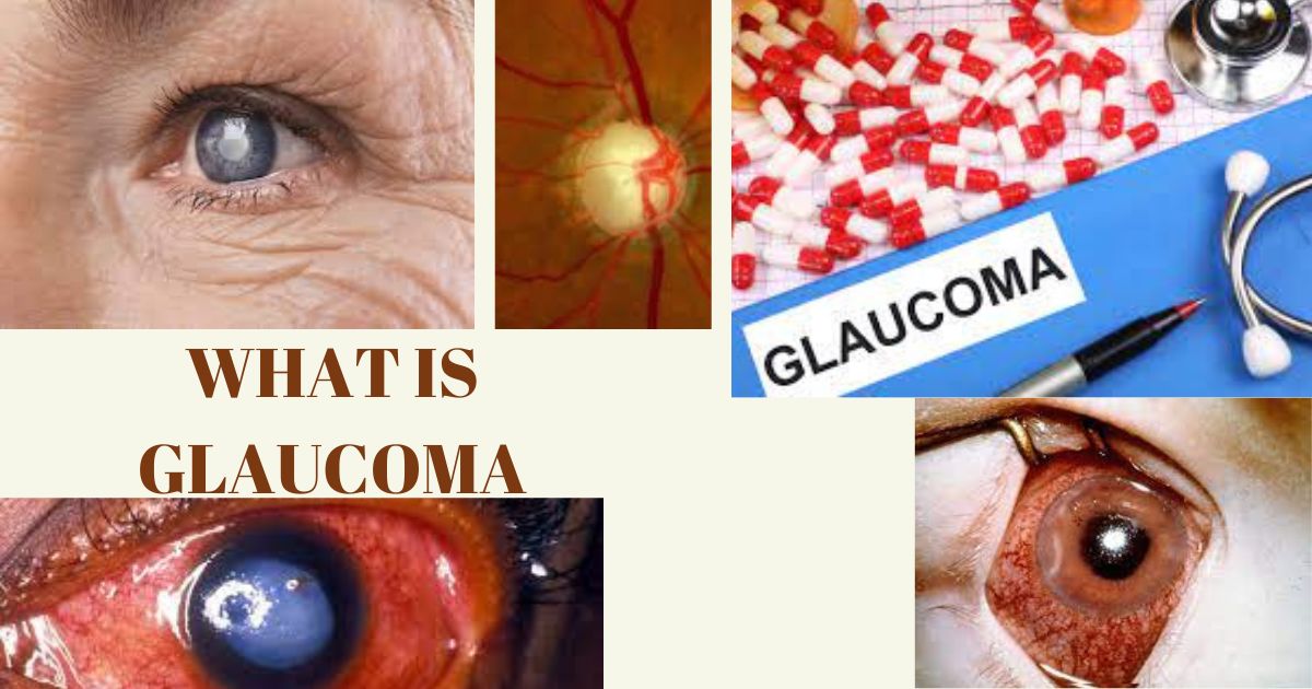 What is Glaucoma