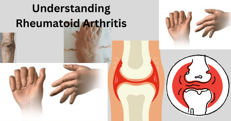 Rheumatoid Arthritis