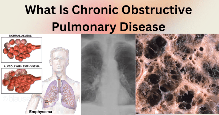 What Is Chronic Obstructive Pulmonary Disease