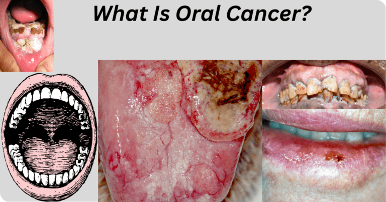 Types of Oral Cancer