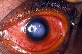 What is Glaucoma