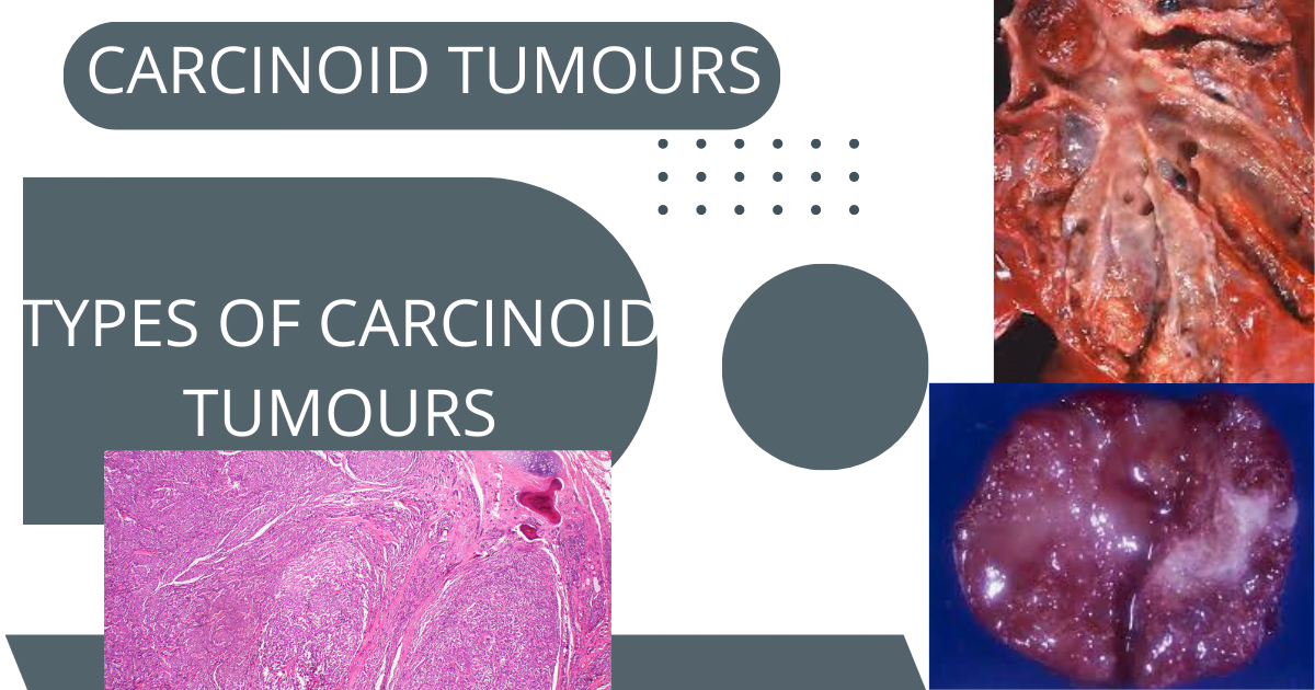 Carcinoid Tumours