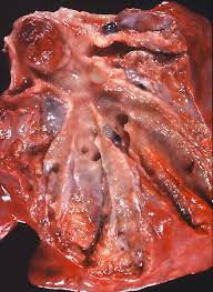 Carcinoid Tumours