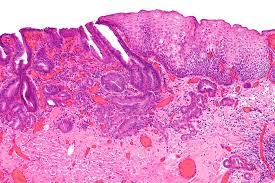 Oesophageal Cancer