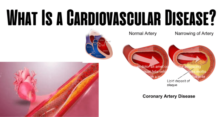 Cardiovascular Disease