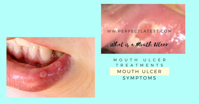 What is a Mouth Ulcer