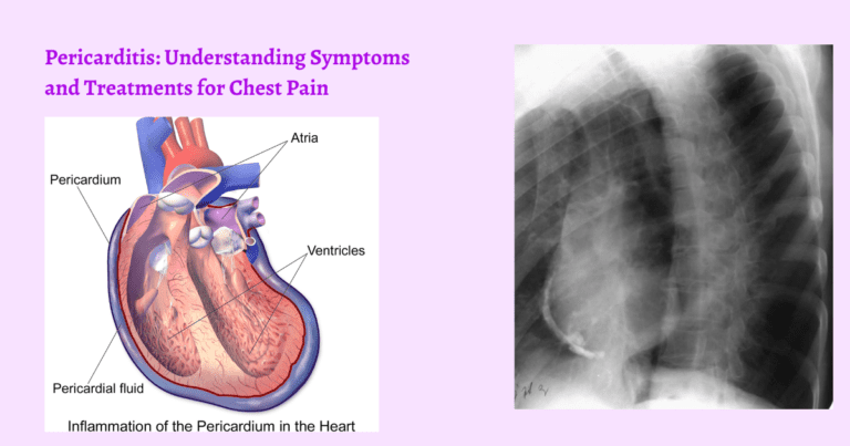 Pericarditis