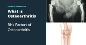 what are the 4 stages of osteoarthritis