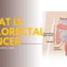 What is colorectal cancer