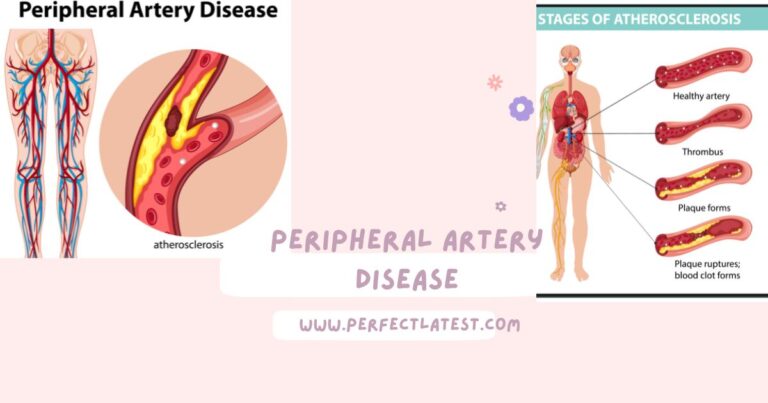 peripheral artery disease