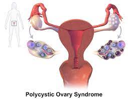Polycystic ovary syndrome electrolysis