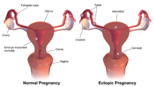 Blocked Fallopian Tubes