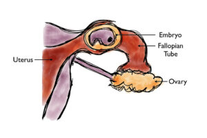 Blocked Fallopian Tubes